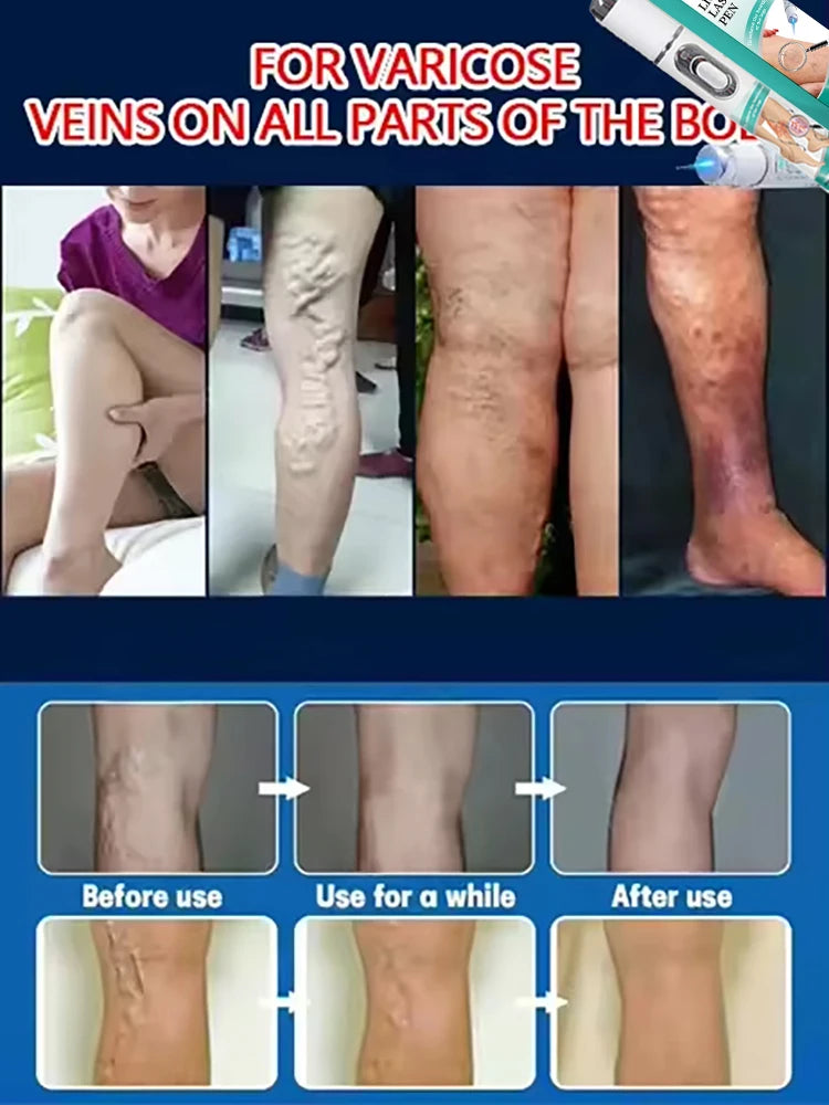 Alivio y Cuidado para Várices y Arañitas Vasculares – Piernas Más Ligeras, Cómodas y Saludables