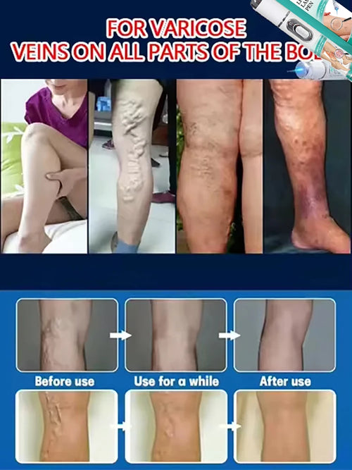 Alivio y Cuidado para Várices y Arañitas Vasculares – Piernas Más Ligeras, Cómodas y Saludables