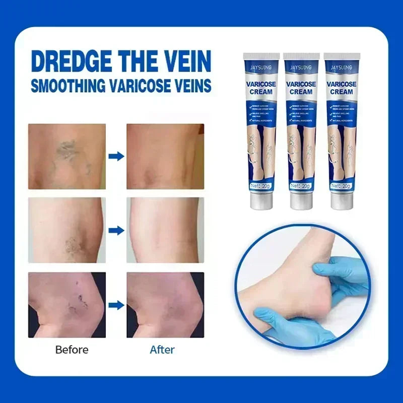 VariRelief™ Crema Herbal para Várices – Alivio Rápido para Piernas Cansadas