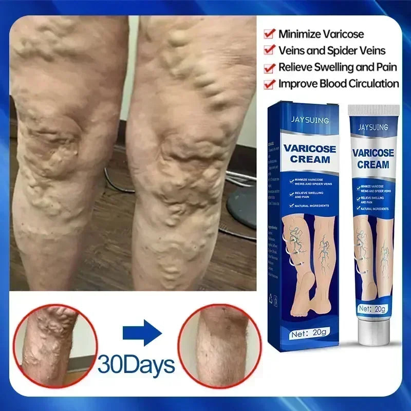 VariRelief™ Crema Herbal para Várices – Alivio Rápido para Piernas Cansadas