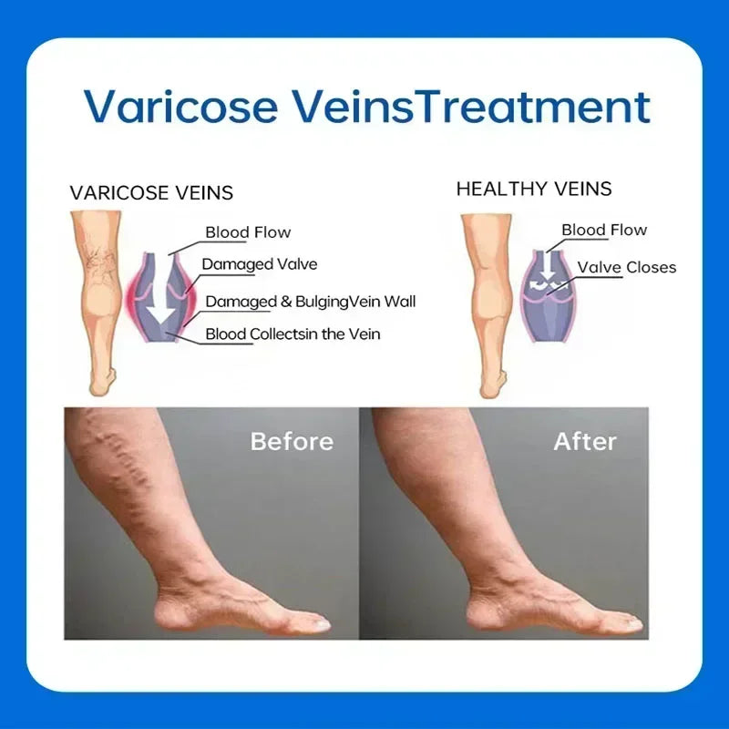 VariRelief™ Crema Herbal para Várices – Alivio Rápido para Piernas Cansadas