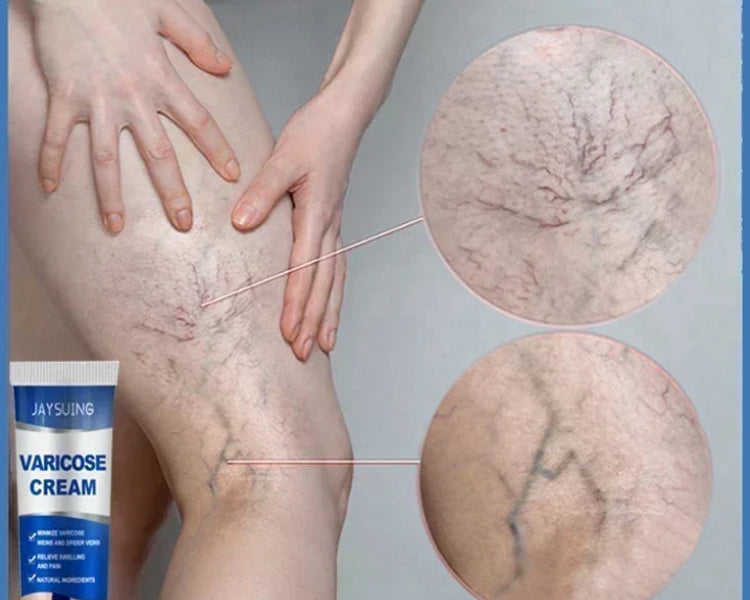 VariRelief™ Crema Herbal para Várices – Alivio Rápido para Piernas Cansadas