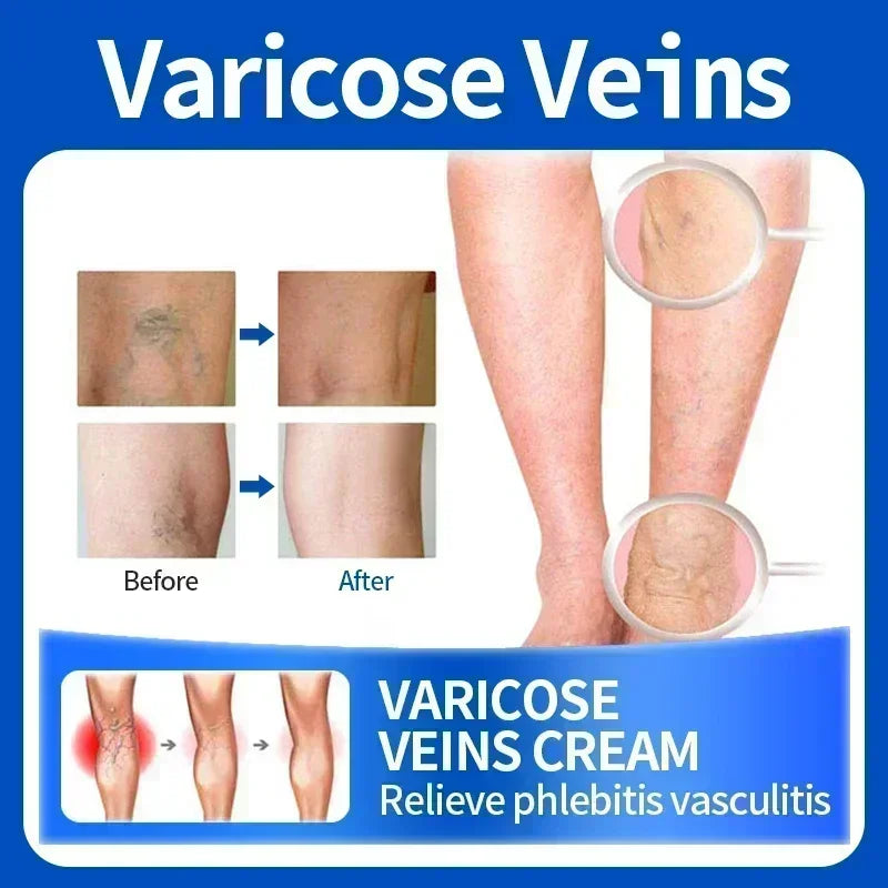 VariRelief™ Crema Herbal para Várices – Alivio Rápido para Piernas Cansadas