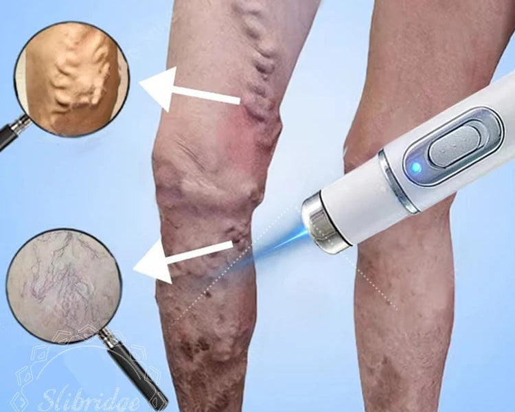 Alivio y Cuidado para Várices y Arañitas Vasculares – Piernas Más Ligeras, Cómodas y Saludables